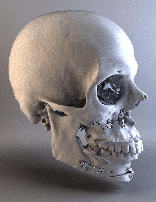 reconstrucción maxilofacial